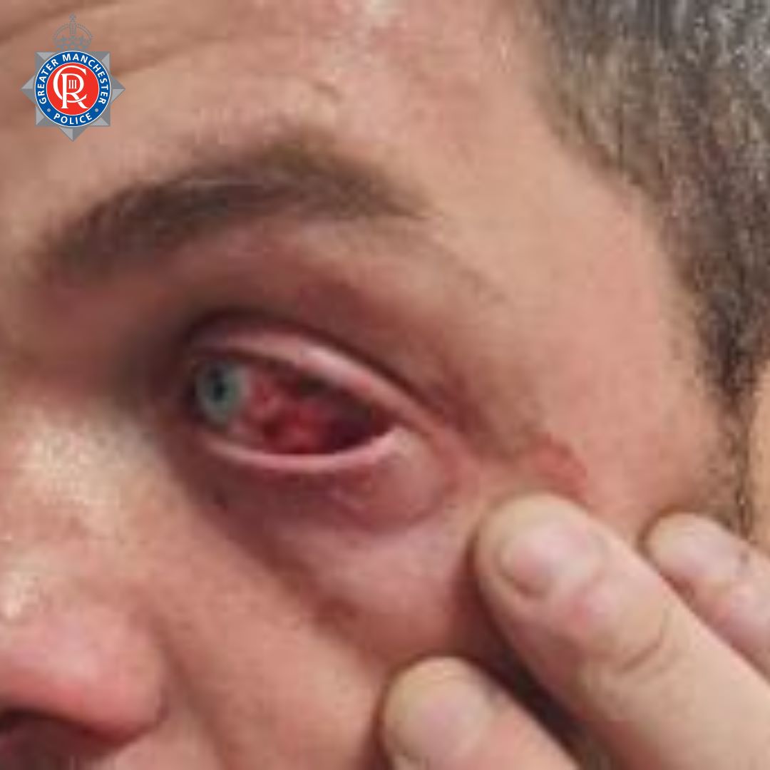Police officer eye injury